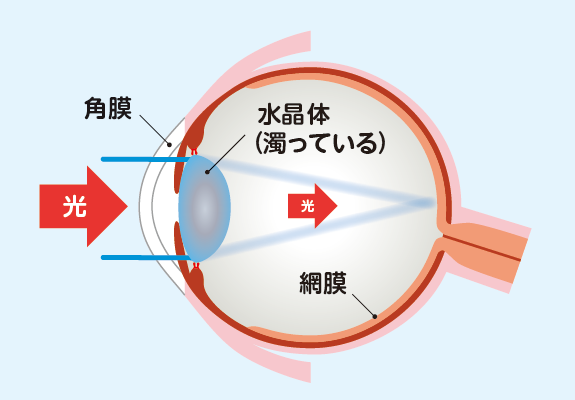 白内障の目